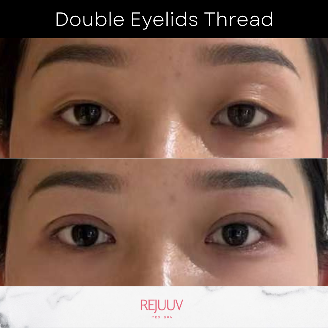 Double eyelid thread before and after — patient 1