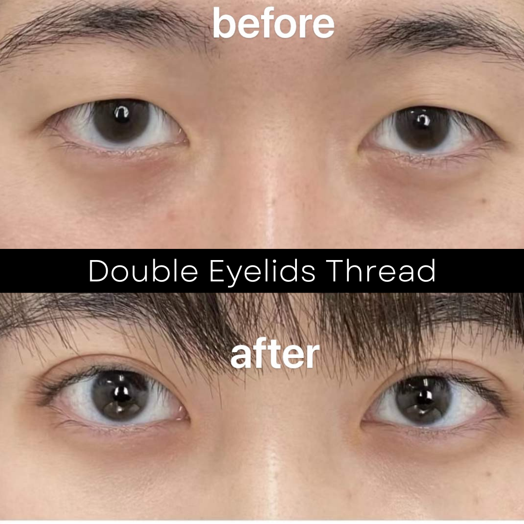 Double eyelid thread before and after — patient 2