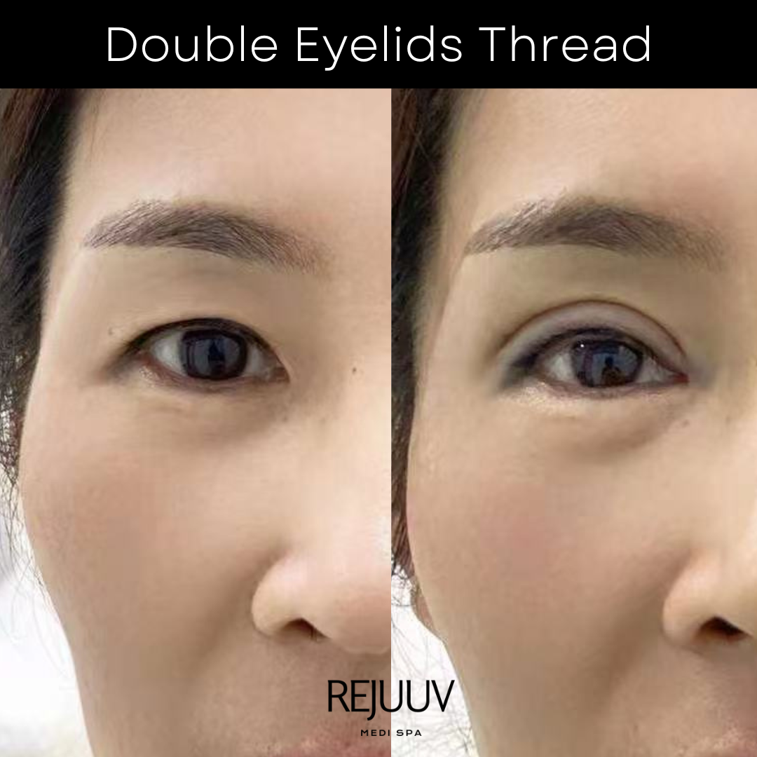 Double eyelid thread before and after — patient 3